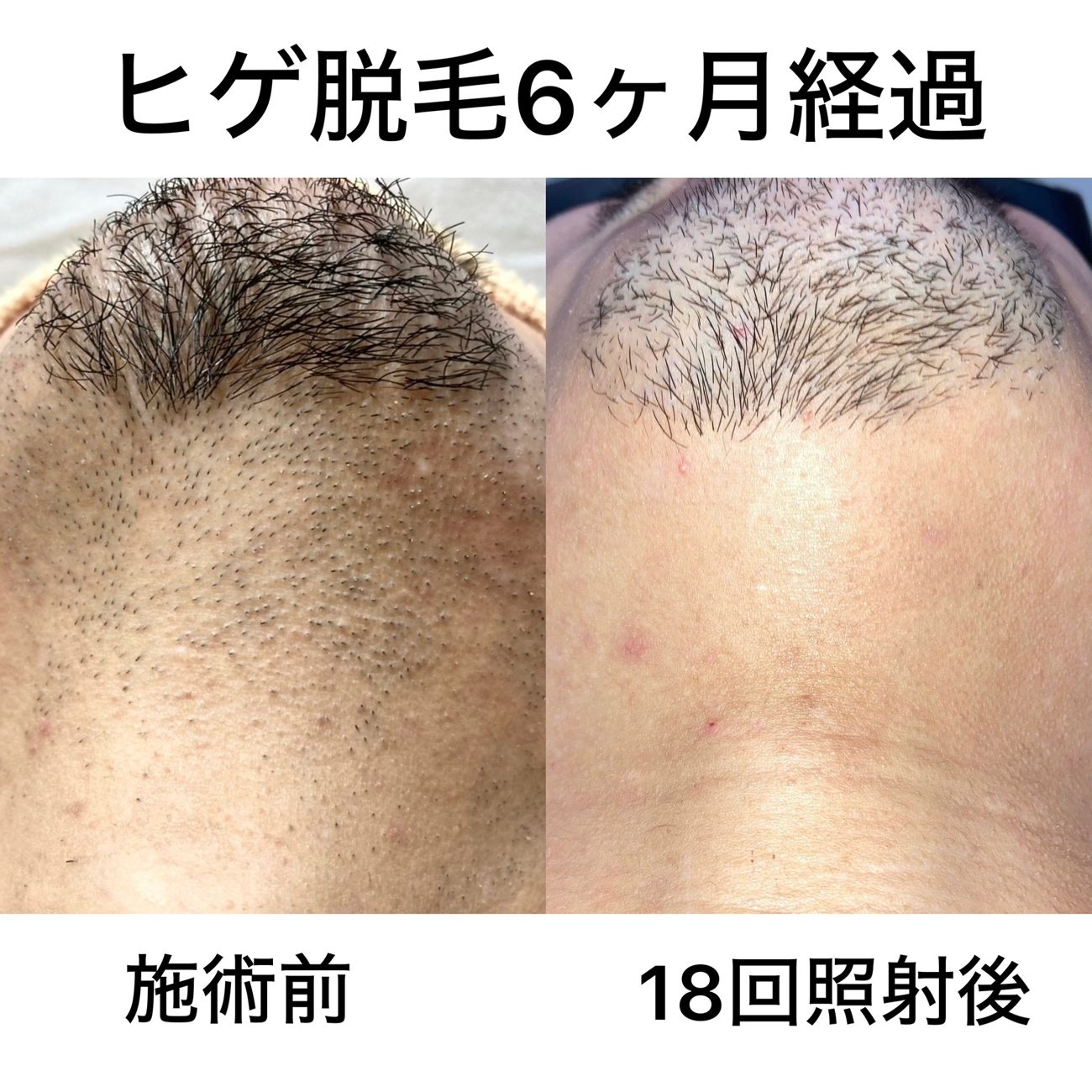 ヒゲ脱毛 18回照射後の症例