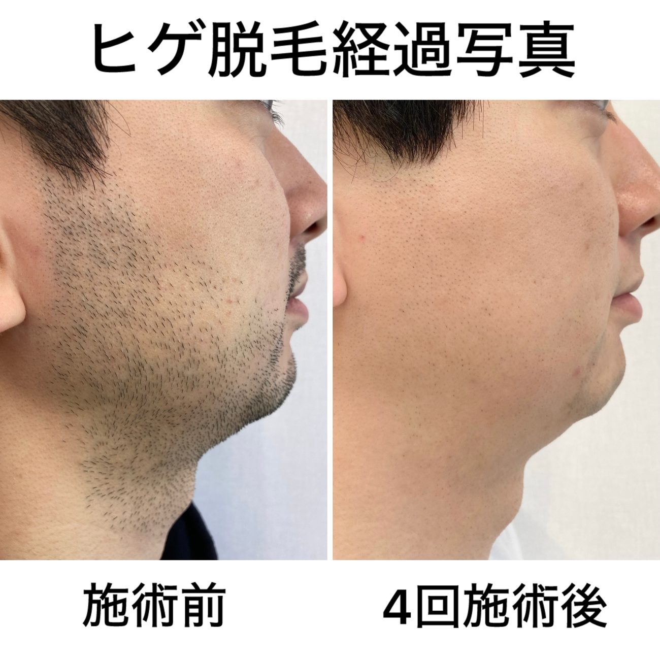 ヒゲ脱毛 4回照射後の症例