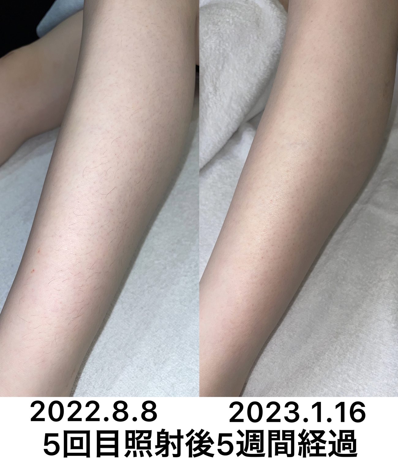 女性ヒザ下脱毛の症例