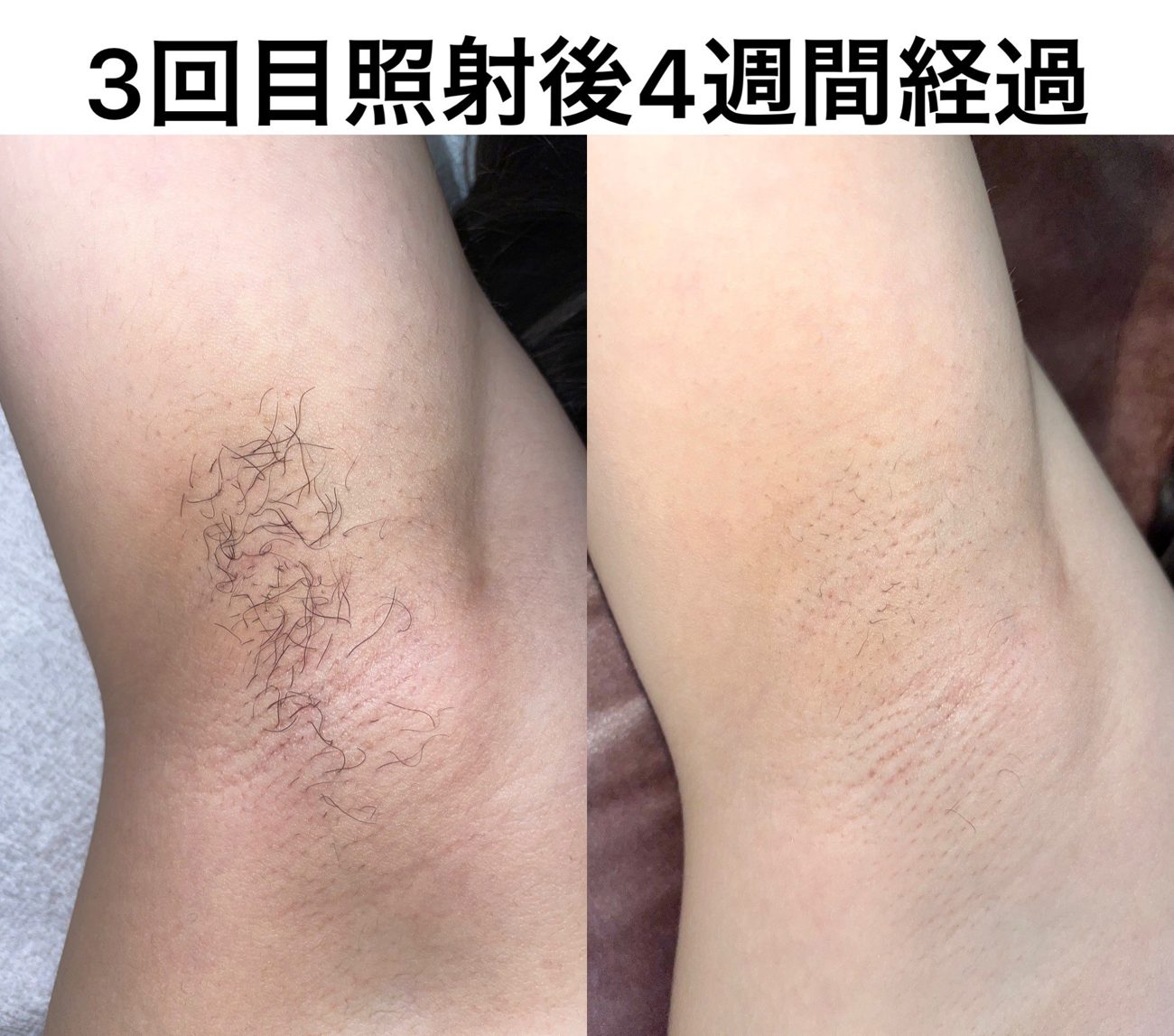 女性ワキ脱毛の症例